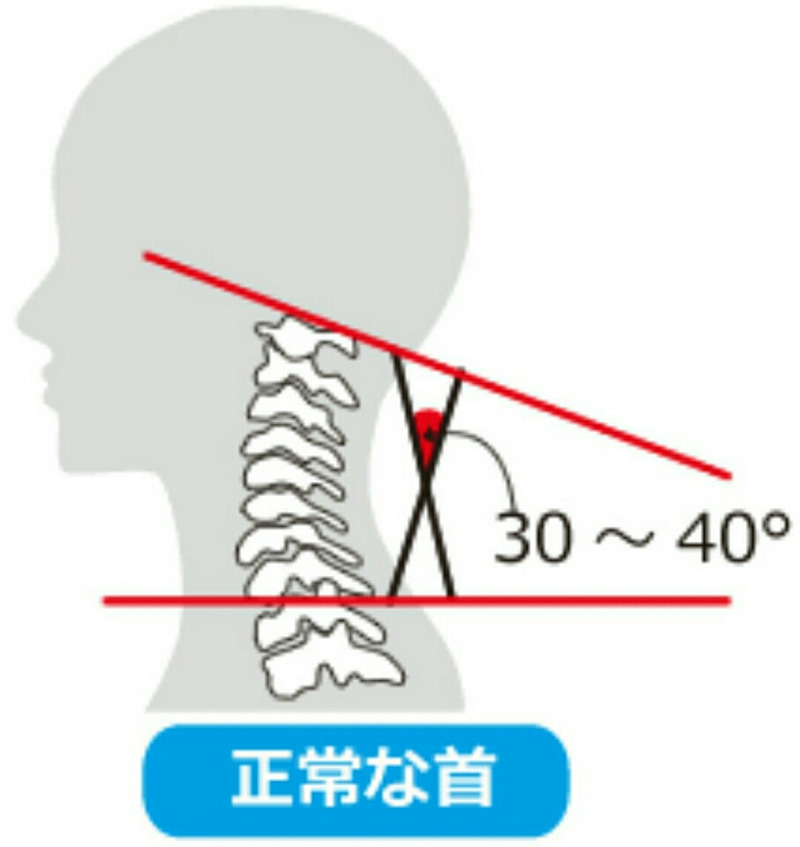 頚椎後弯