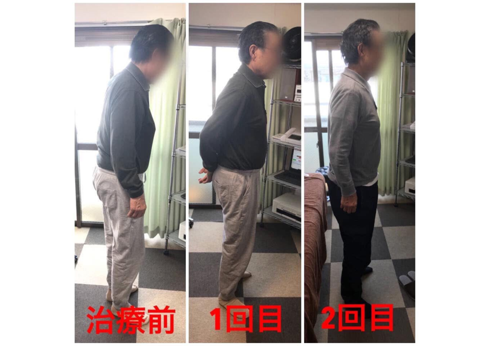 70代　男性　ギックリ腰で来院